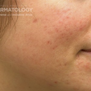 Erythema_B_PIH_Acne1.jpg