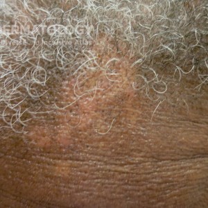 sarcoid type E scalp_Friedman.jpg