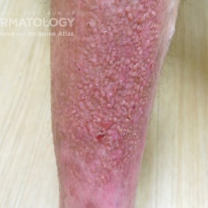 lichen amyloid leg type B.jpg