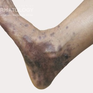 hyperpigmentation type e foot11.jpg