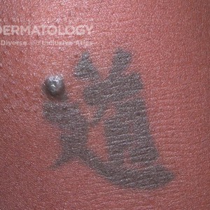 Sarcoidosis in a Tatoo_E_DIR56345.jpg