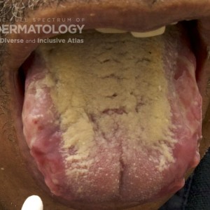 Pemphigus Vulgaris_D_Tongue.jpg