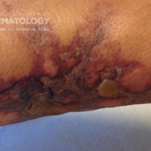 Calciphylaxis_DIR 60861.jpg