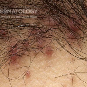 Acne Keloidalis Nuchae_B_Closeup11.jpg