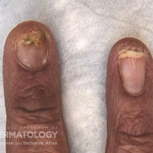 Psoriatic_Nail_D_Closeup4.jpg