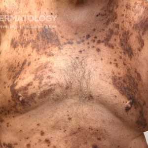 Psoriasis_C_Chest.jpg