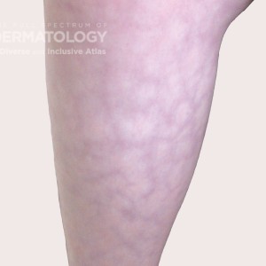 livedo reticularis type A_Leg.jpg