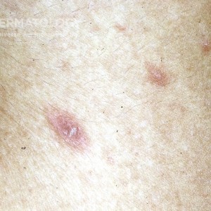 Pityriasis Rosea_A_Cohen.jpg