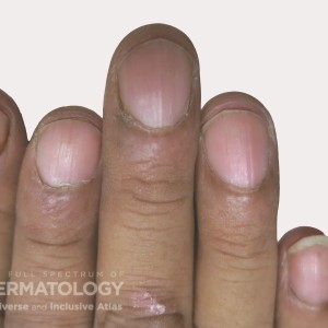 psoriasis with nail_C_11.jpg