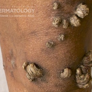 Keratosis Lichenoides Chronica_D_closeuplegs2.jpg