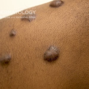 Keloid_E_Shoulder_2.jpg