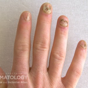 Nail_Psoriatic_233_A.jpg