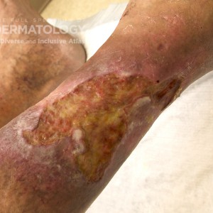 pyoderma gangrenosum_B_PG_4.jpg