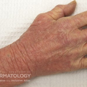 Erythroderma_a_hand5.jpg