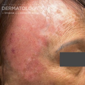 Dermatomyositis_C_Carrington_1.jpg