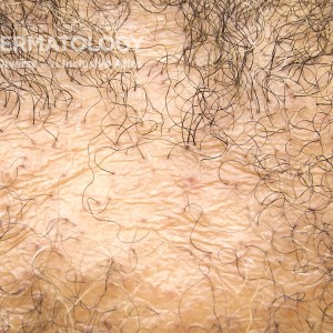 CCCA_D_Scalp_Closeup2.jpg