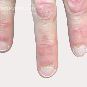 Dermatomyositis_A_DIR60984_.jpg