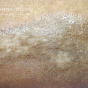 morphea type D abdomen.jpg