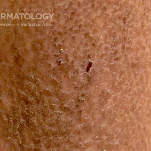 Macularamyloidosis_c_leg4_closeup.jpg