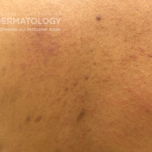 Erythema_D_Adusumilli_Back1.jpg