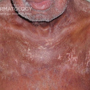 Dermatomyositis_D_ 56309.jpg