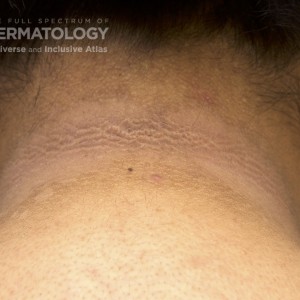 Acanthosis_Nigricans_B_Neck2.jpg