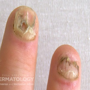 Nail_Psoriatic_Closeup233_A.jpg