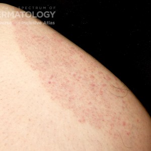 Tinea_corporis_b.jpg