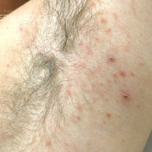 Pityriasis_Lichenoides et Varioliformis type A_Friedman.jpg