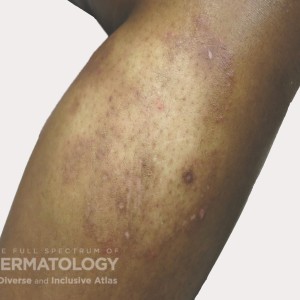 hypopigmentation type E  leg.jpg