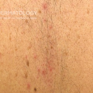 Folliculitis_B_Back_Closeup2.jpg