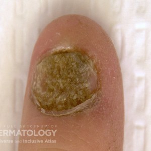 psoriaticnail_a_Finger_Closeup.jpg