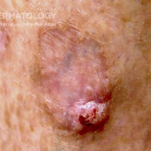 Squamous_Cell_Carcinoma_a_closeup5.jpg