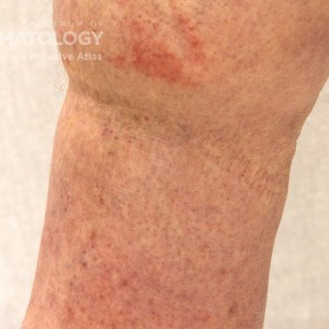 PigmentedPurpuricDermatosis_B_extremities3.jpg