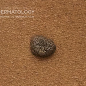 Intradermal_Nevus_Trunk_E.jpg