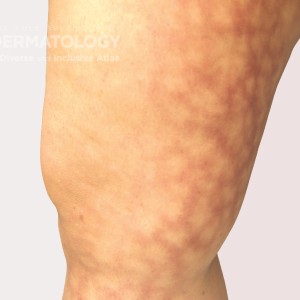 Livedo_Reticularis_A_leg.jpg