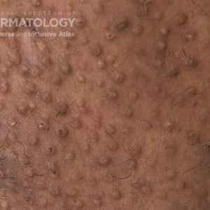 Cutaneous_Amyloid_D_Leg_Closeup2.jpg