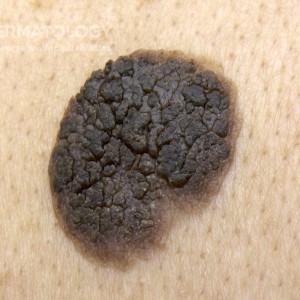 seborrheic_keratosis_A_Back_1_closeup.jpg