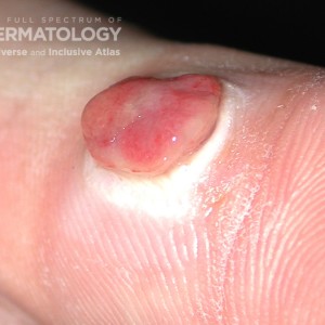 Pyogenic Granuloma 1 closeup.jpg