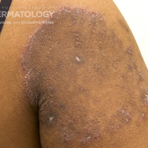 Tinea_Corporis_E.jpg