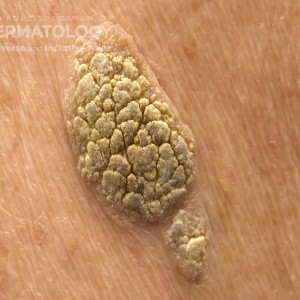 Seborrheic_keratosis_b_back_closeup.jpg