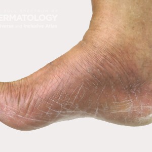 secondary syphilis type D_Foot_.jpg