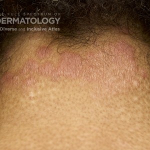 Erythema_D_Adusumilli_Neck.jpg