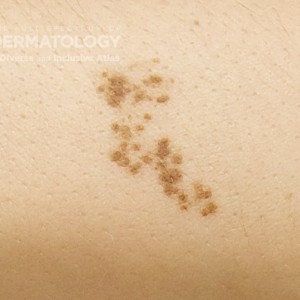 Nevus Spillus_Forearm_A.jpg