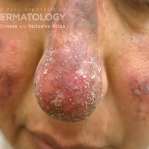 Severe Discoid Lupus Erythematosus.jpg