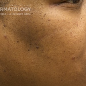 Melasma_E_Cheek6.jpg