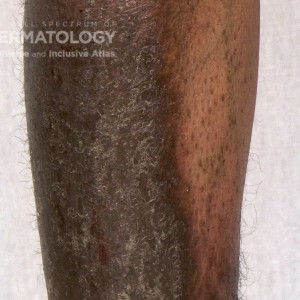 Psoriasis_D_Leg_closeup.jpg