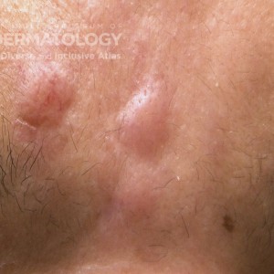 Sarcoidosis_B_Forehead3_Closeup.jpg