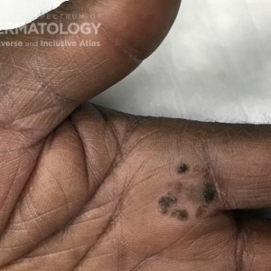 Squamous_Cell_Carcinoma_D_Hand_2.jpg