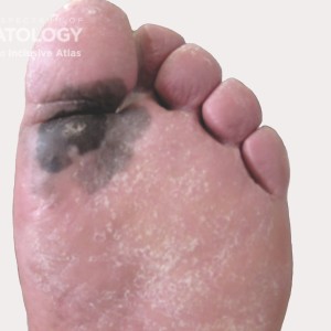 acral lentiginous melanoma_.jpg